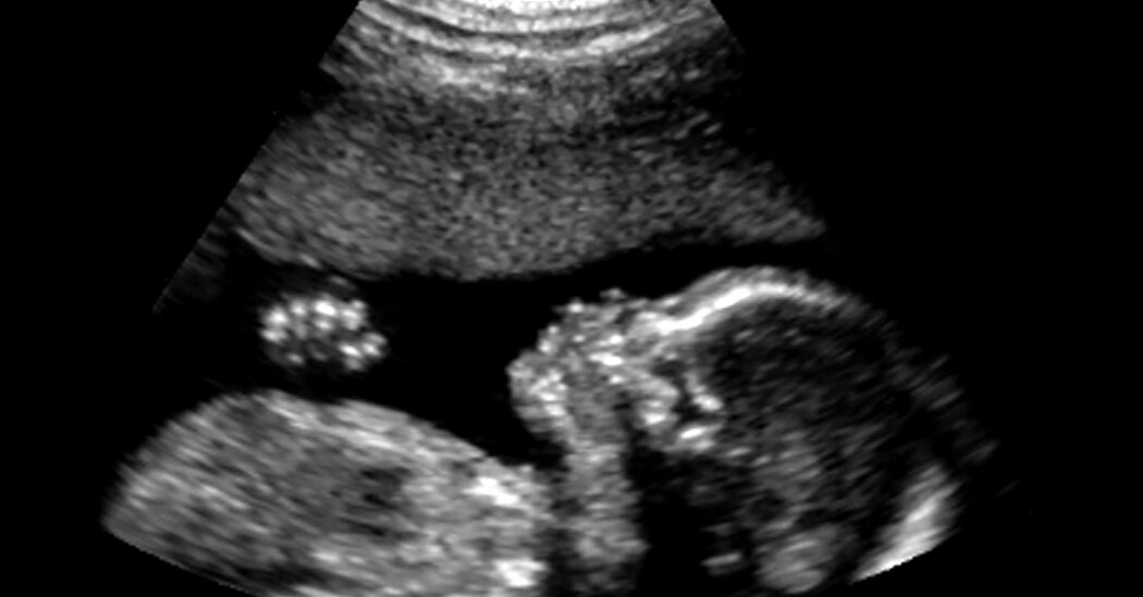 Cash Aid to Poor Mothers Improves Brain Function in Babies, Study Finds