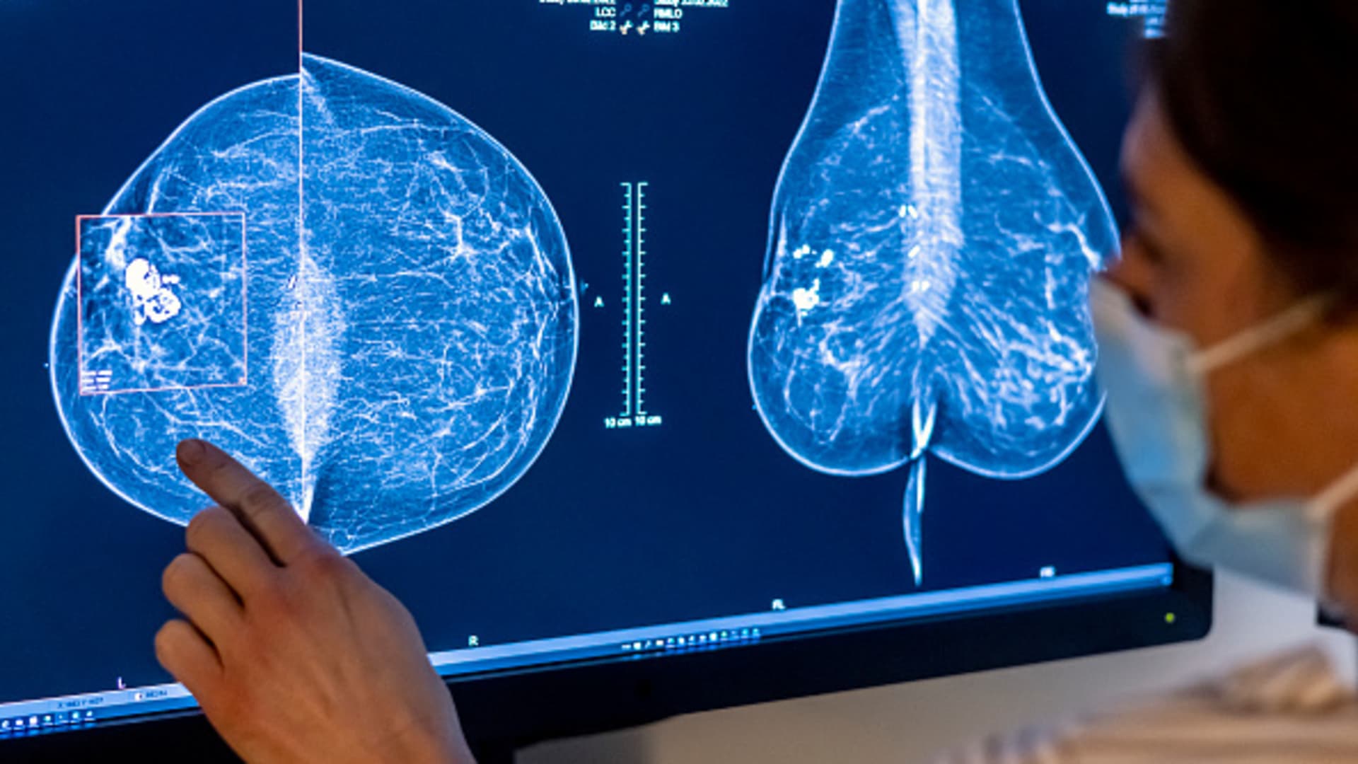 Breast cancer screenings should start at age 40